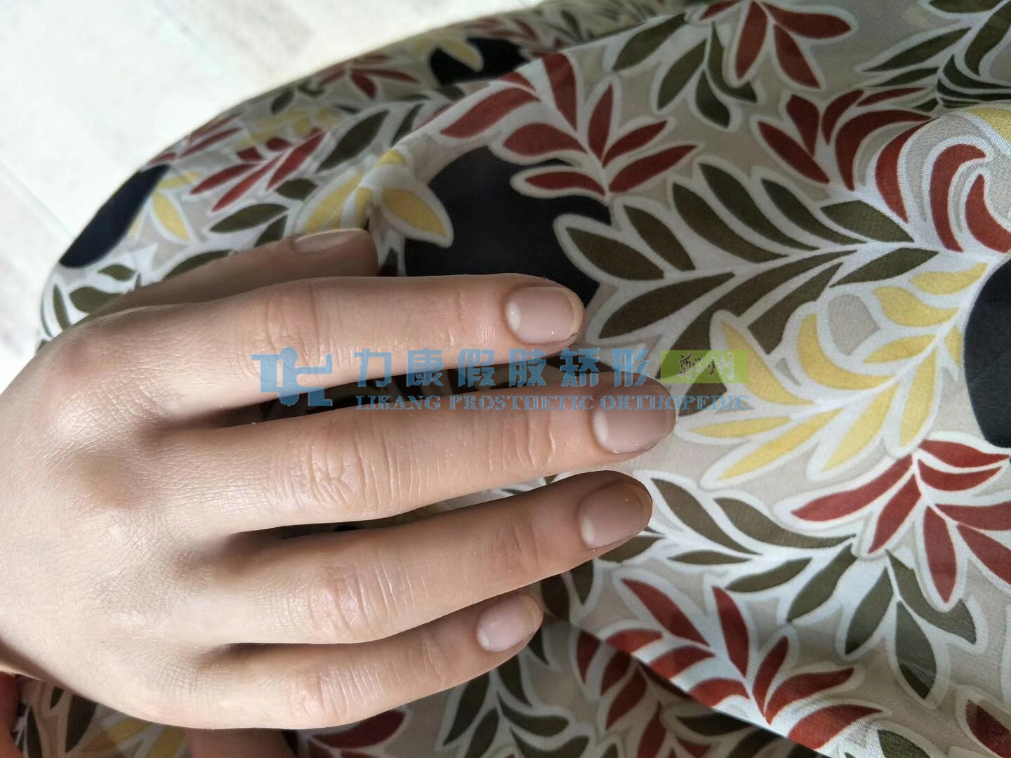 手指假肢價(jià)格多少如何進(jìn)行安裝(圖1) 手指假肢價(jià)格多少如何進(jìn)行安裝(圖1)